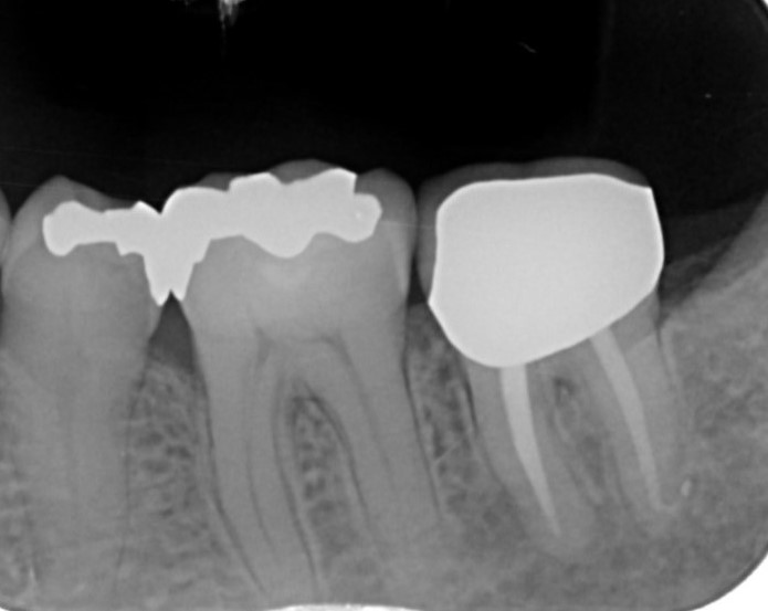 精密根管治療（下顎第二大臼歯）