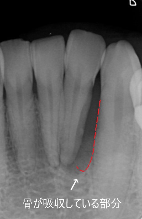 歯周組織再生療法（下顎前歯）
