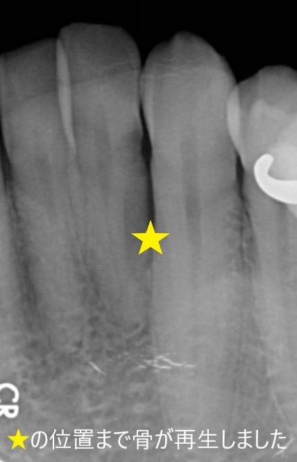 歯周組織再生療法（下顎前歯）