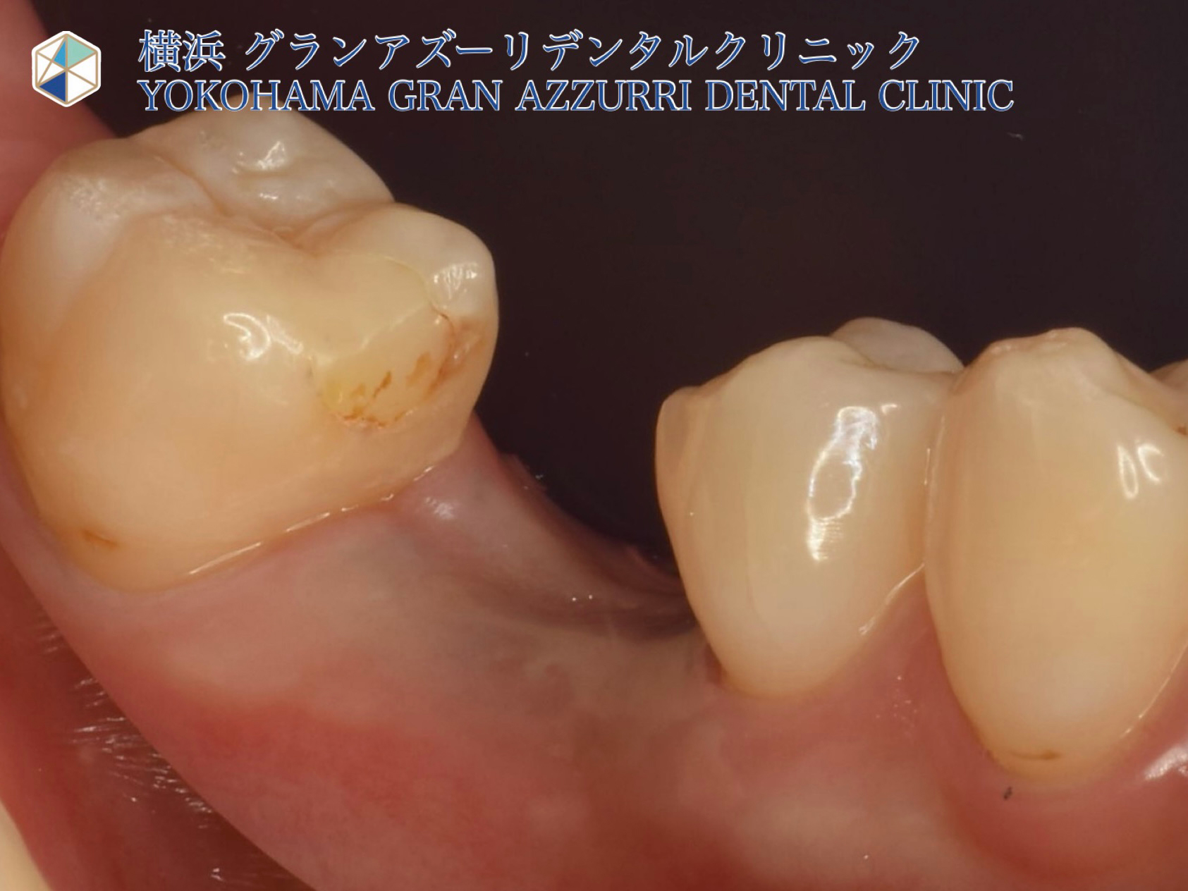 インプラント治療(右下大臼歯)