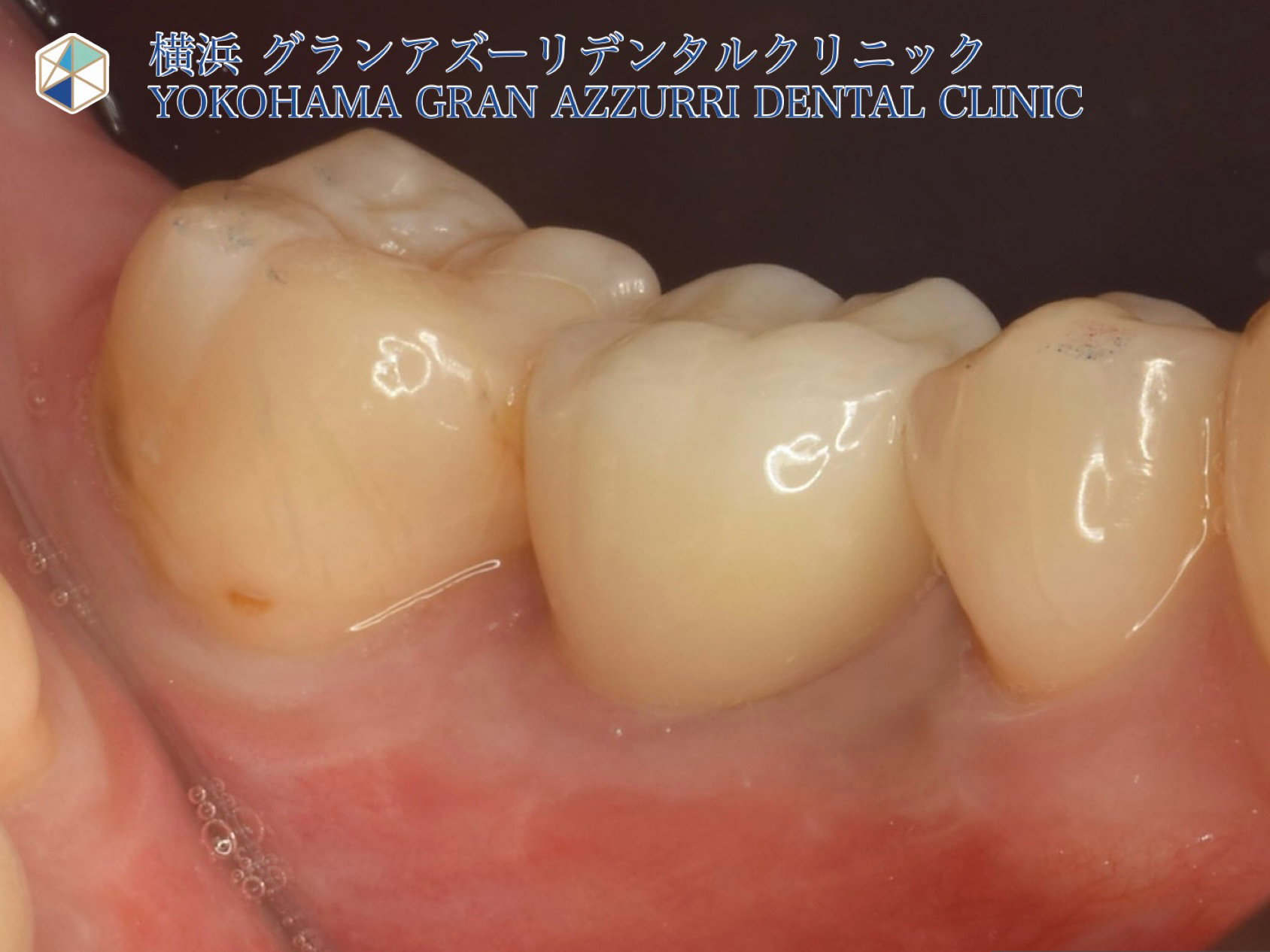インプラント治療(右下大臼歯)