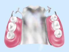 コバルトクロム義歯