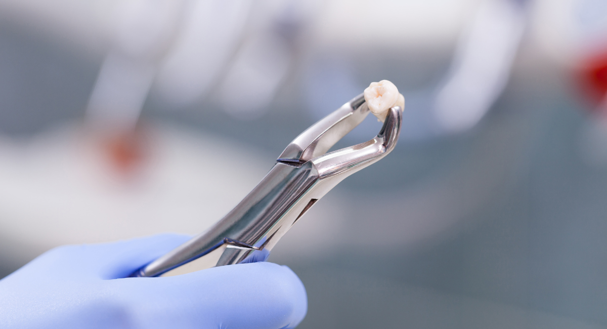 抜歯が必要になるケースとは