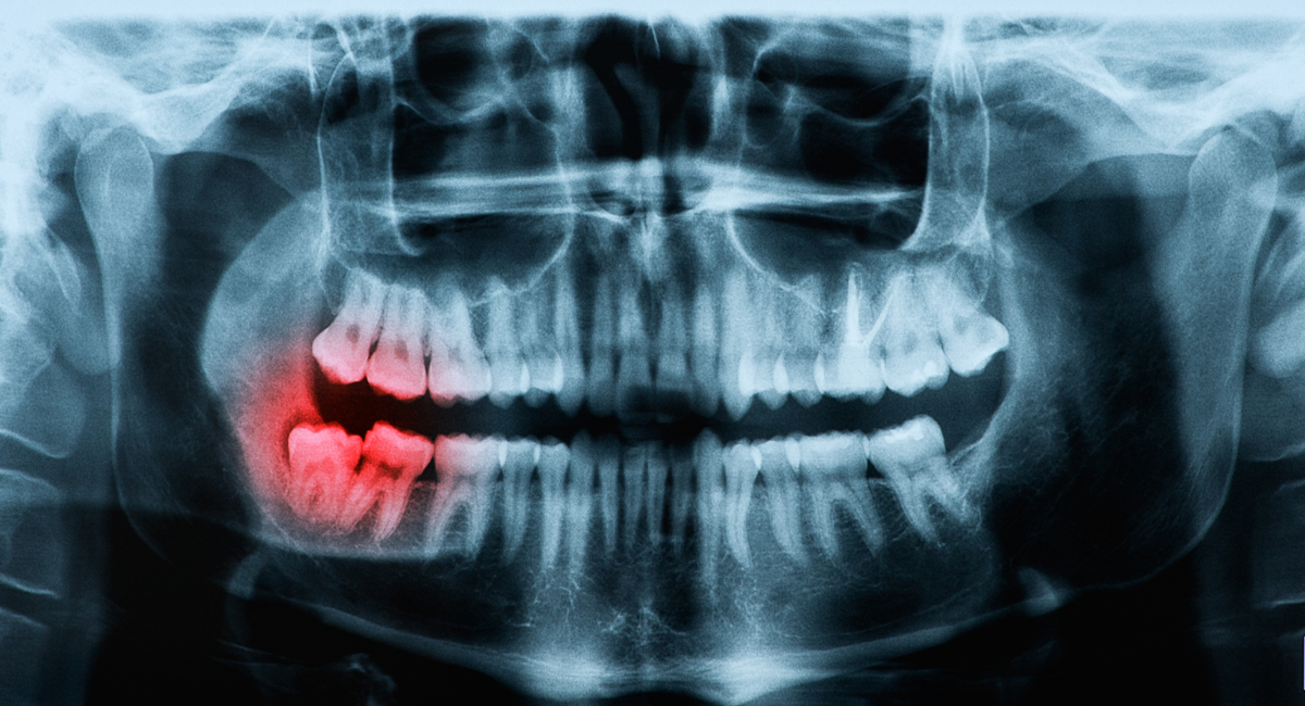 親知らずが引き起こすお口のトラブルとは
