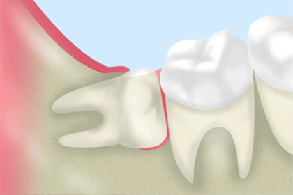 親知らずは抜歯しなければいけないの？