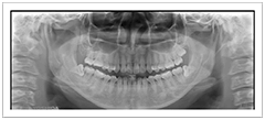 親知らずの抜歯の難易度と症例