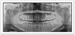 親知らずの抜歯の難易度と症例