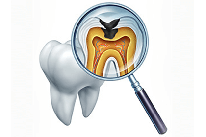 虫歯がどんな病気か、知っていますか？