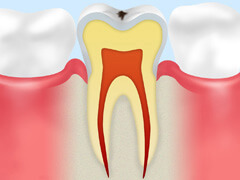 CO：歯の表面の虫歯
