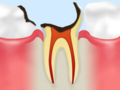 C4：歯根に達した虫歯