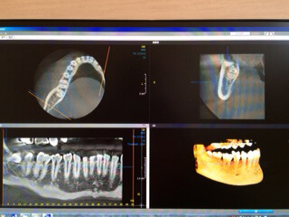 歯科用CT