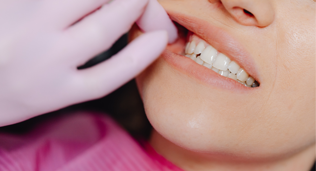 「ただ白くする」ホワイトニングでは満足できない理由