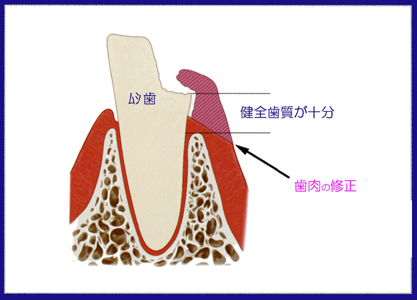 歯冠長延長術