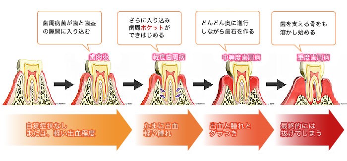 歯周病って...