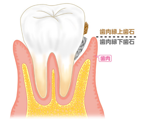 歯周病治療の第2ステップ★SRP★