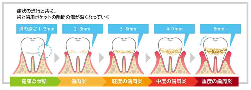 ★歯周病治療の道のり★