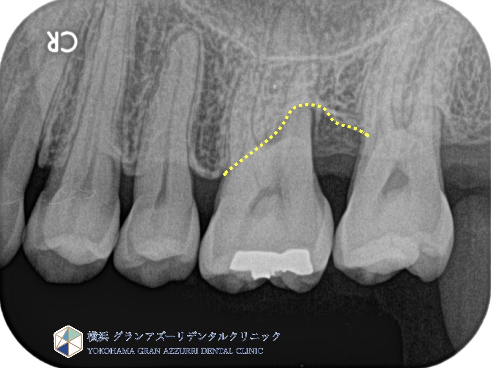 歯周組織再生療法（第一大臼歯）