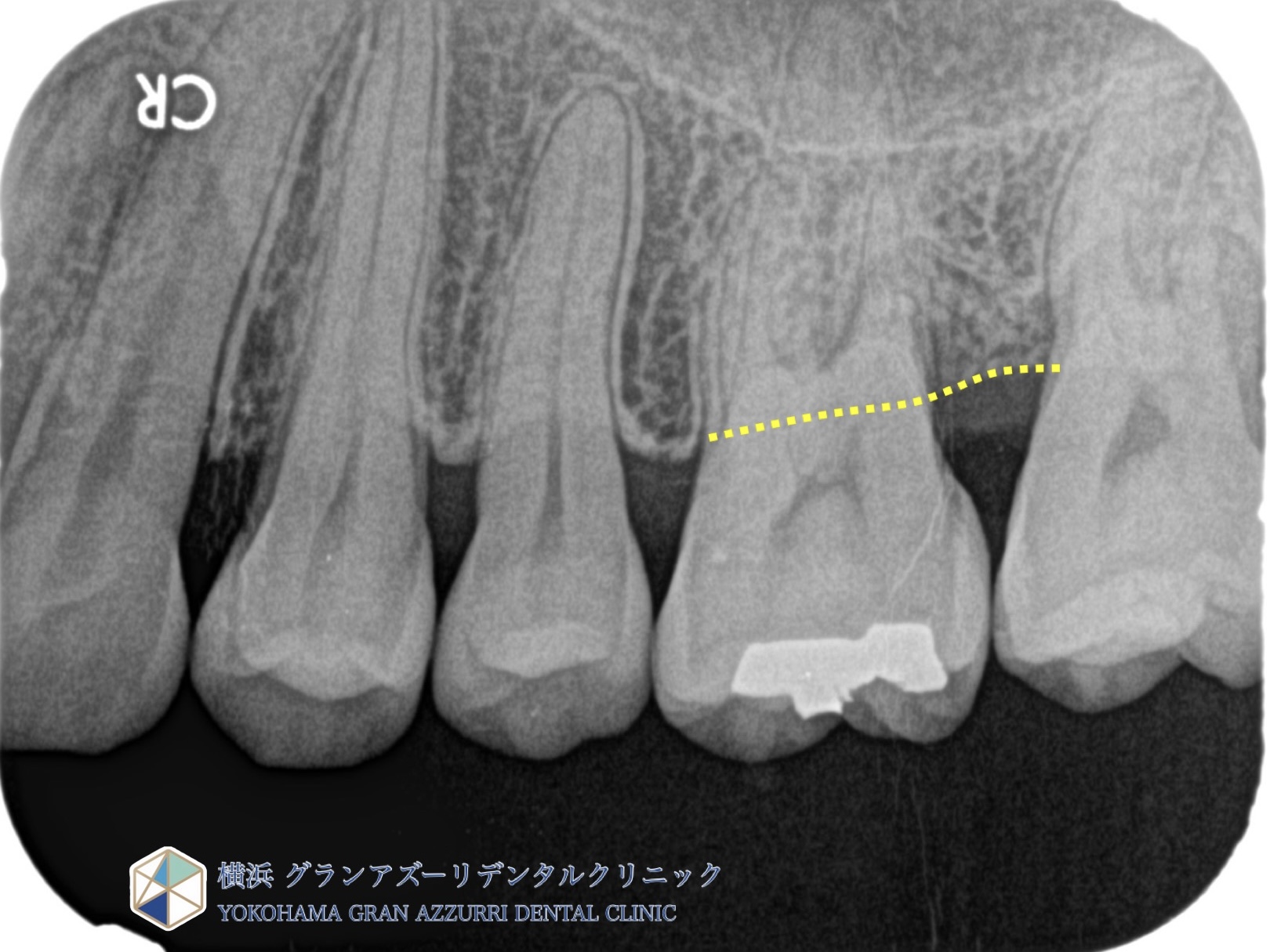 歯周組織再生療法（第一大臼歯）
