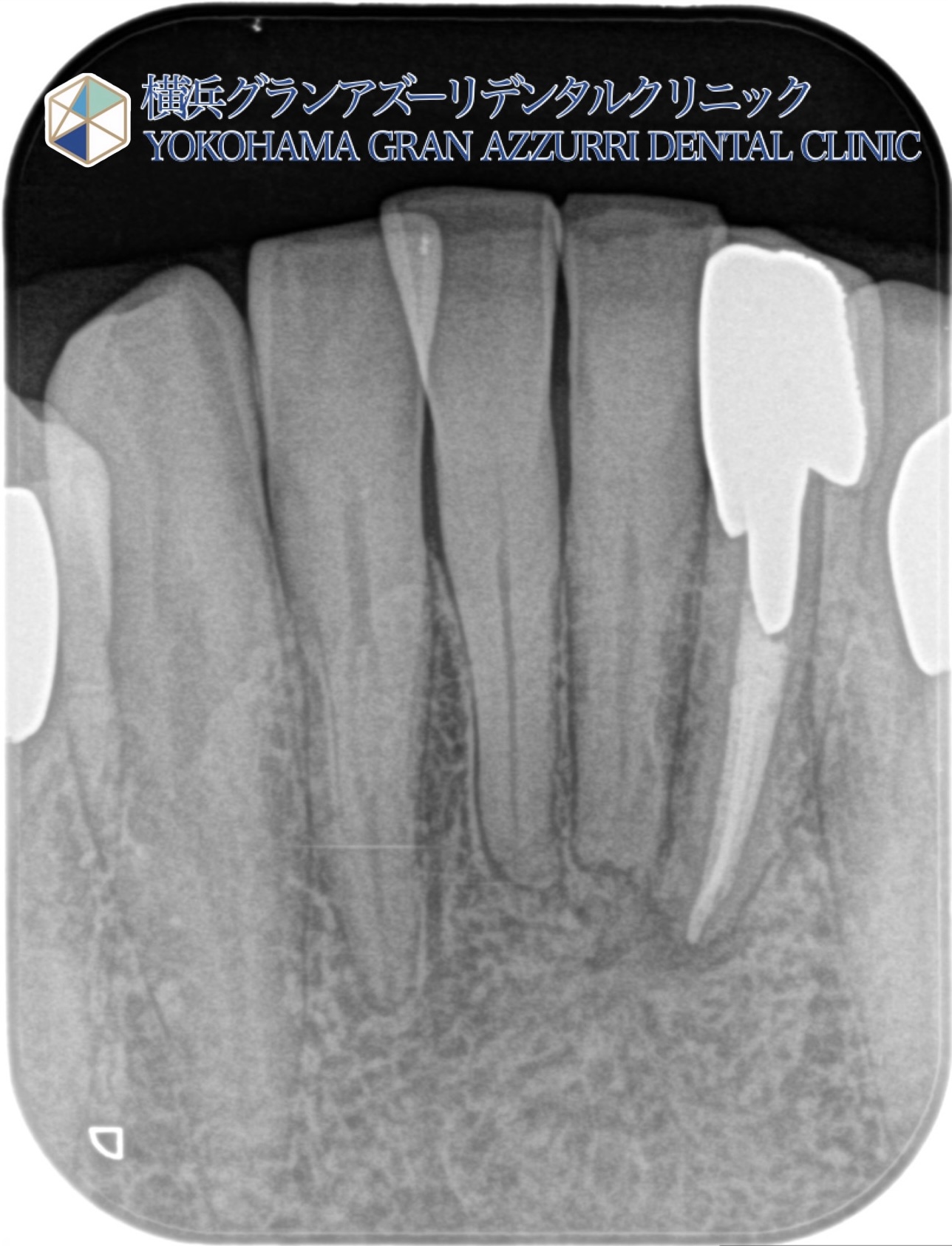 精密根管治療（下顎前歯）