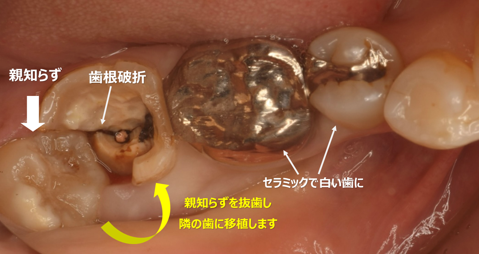 歯の移植