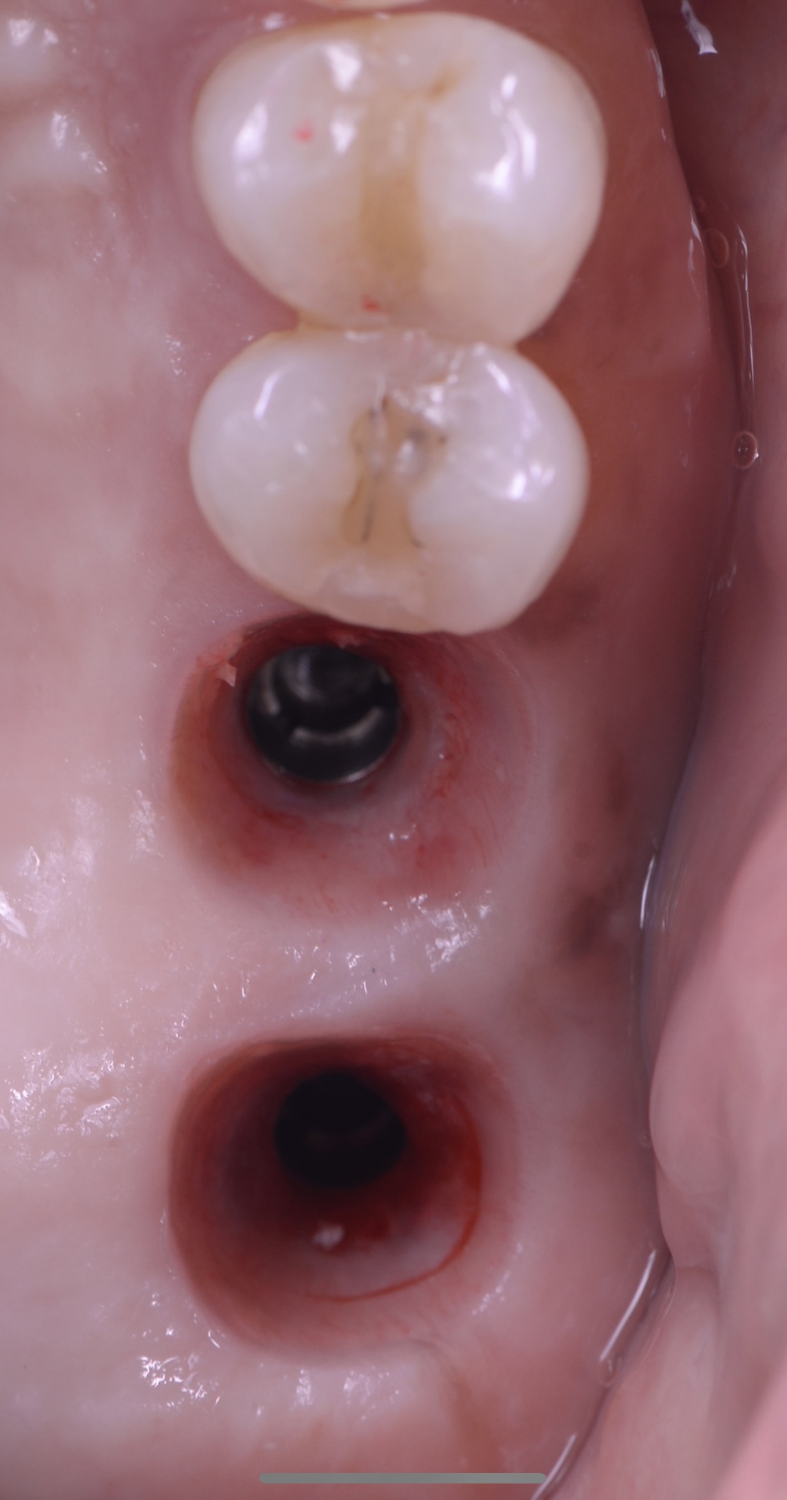 インプラント（Socket Lift）