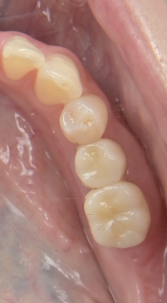 インプラント（単純埋入２本）