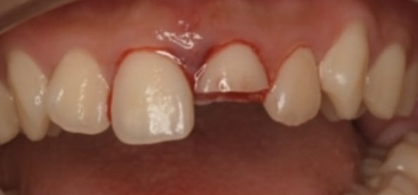 外傷（MTA＆オールセラミッククラウン）