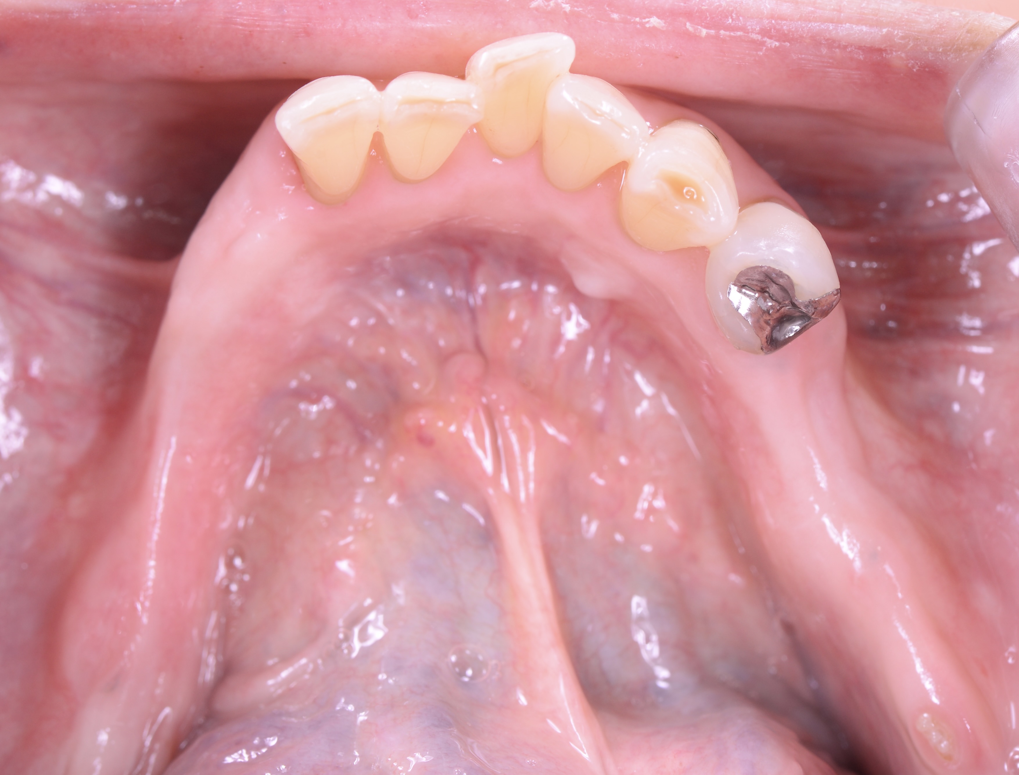 コバルト金属床義歯