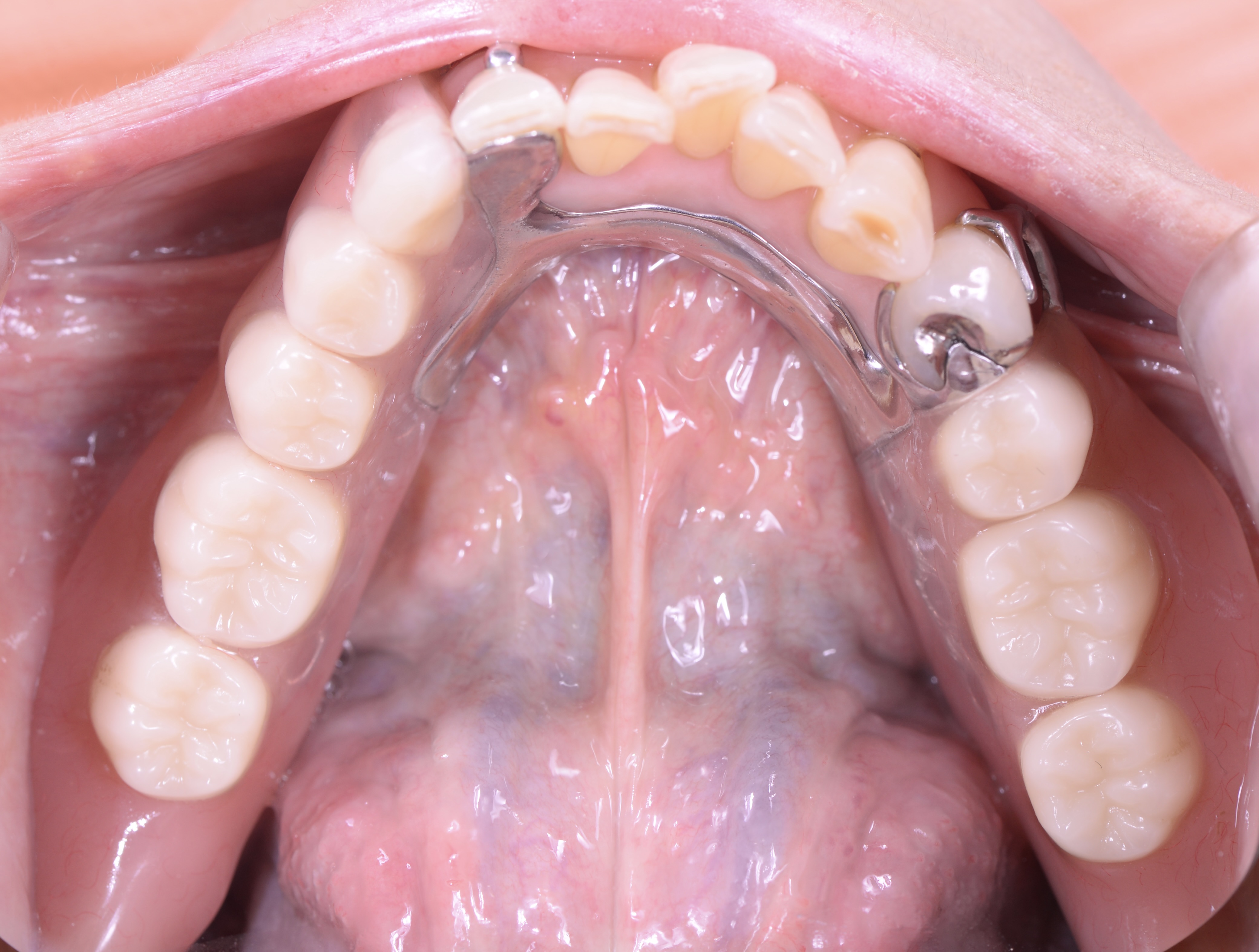 コバルト金属床義歯