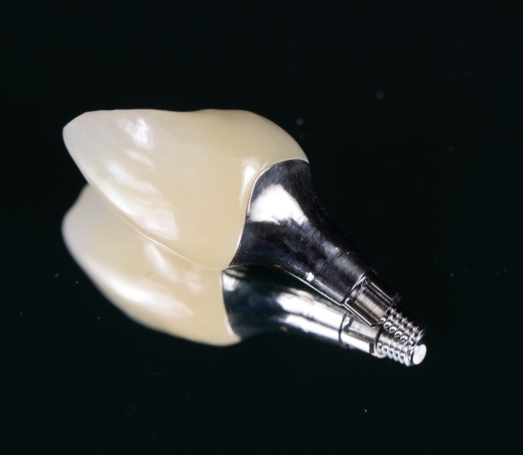 前歯インプラントSST（Socket Shield Technique））