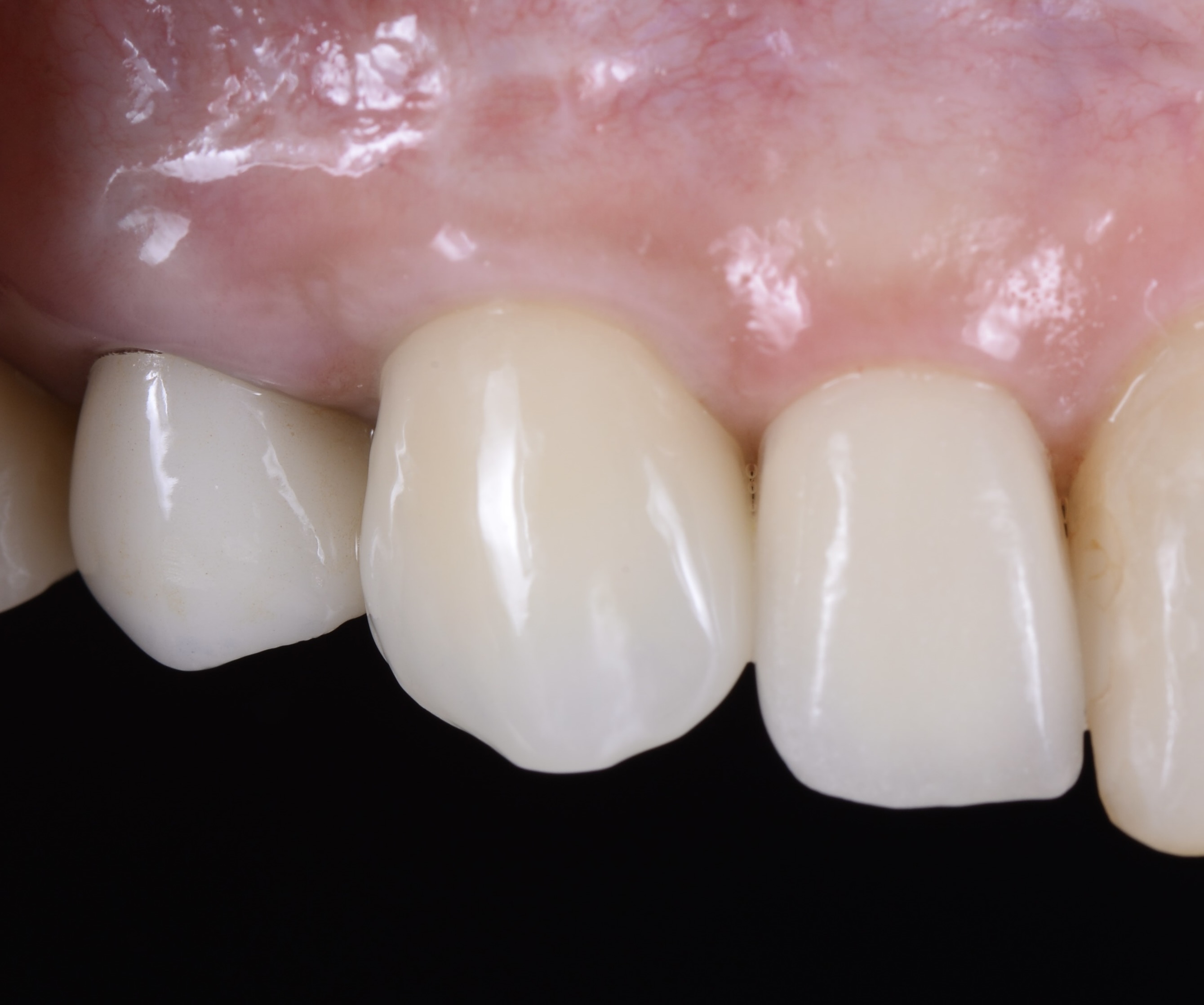 前歯インプラントSST（Socket Shield Technique））