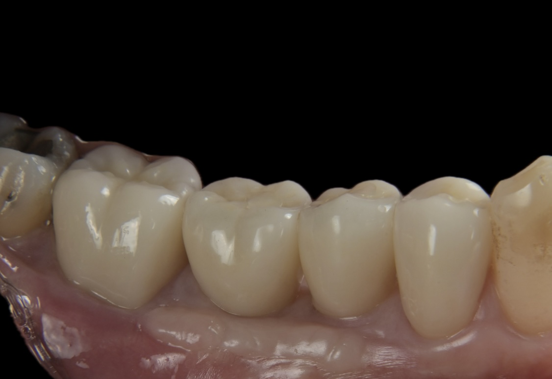 インプラント（GBR＆FGG）