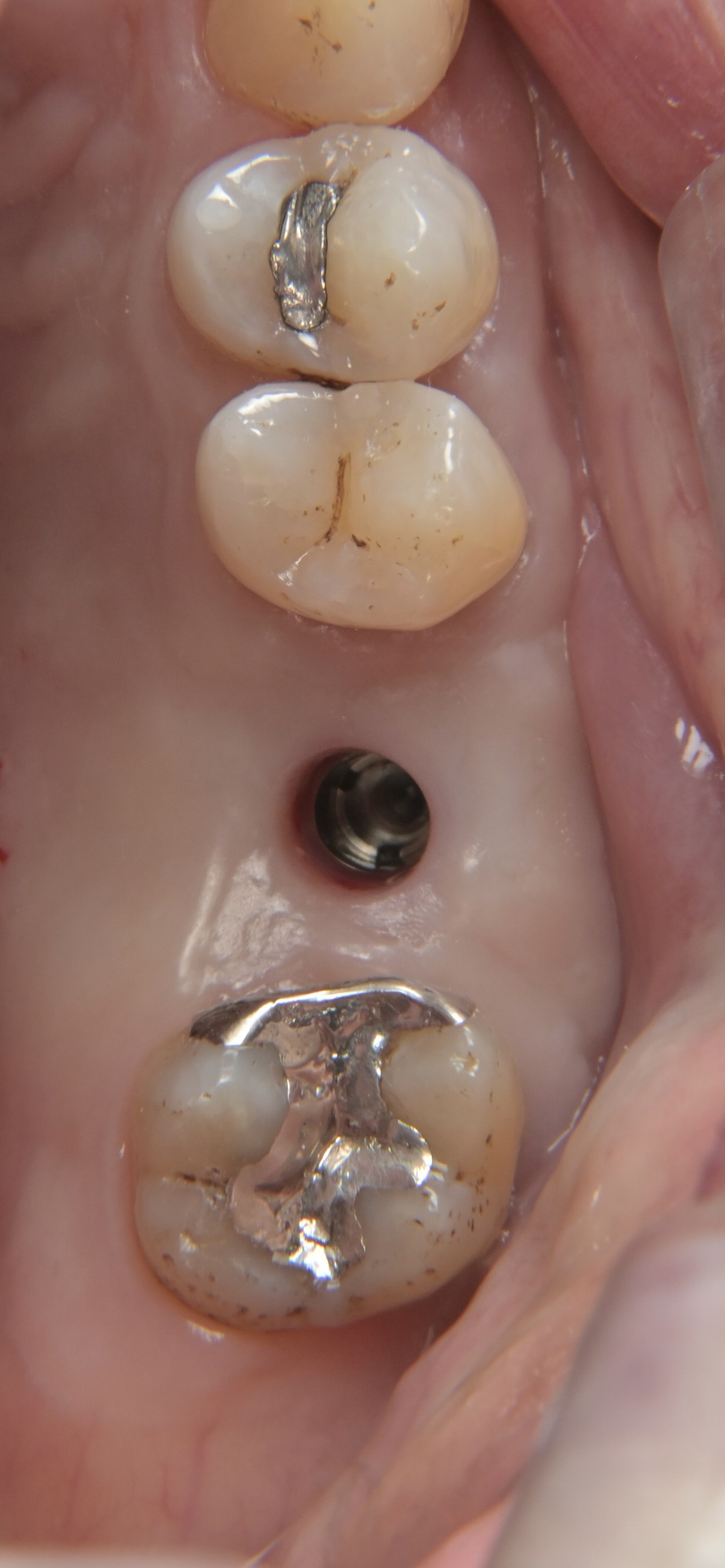 インプラント（単純埋入）