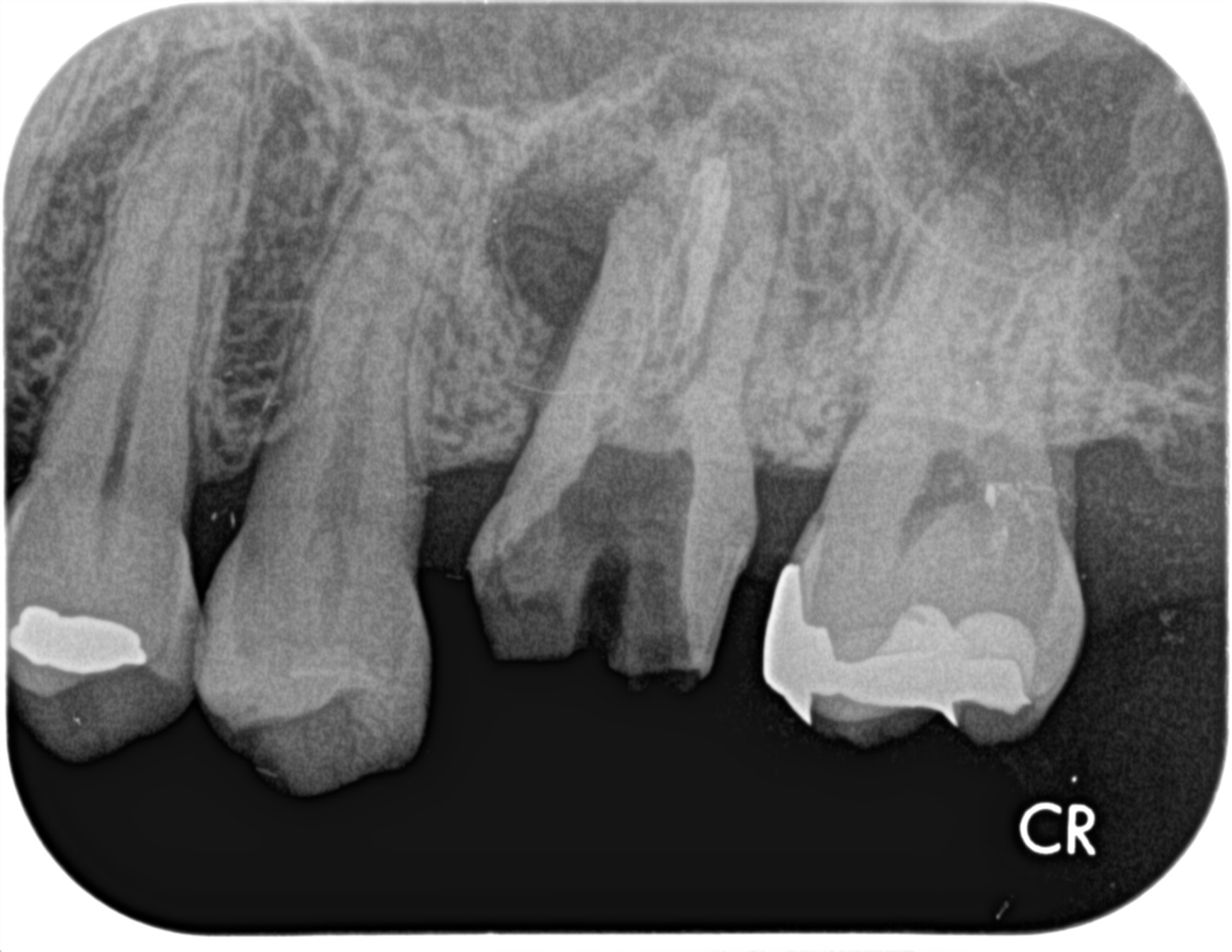 インプラント（単純埋入）