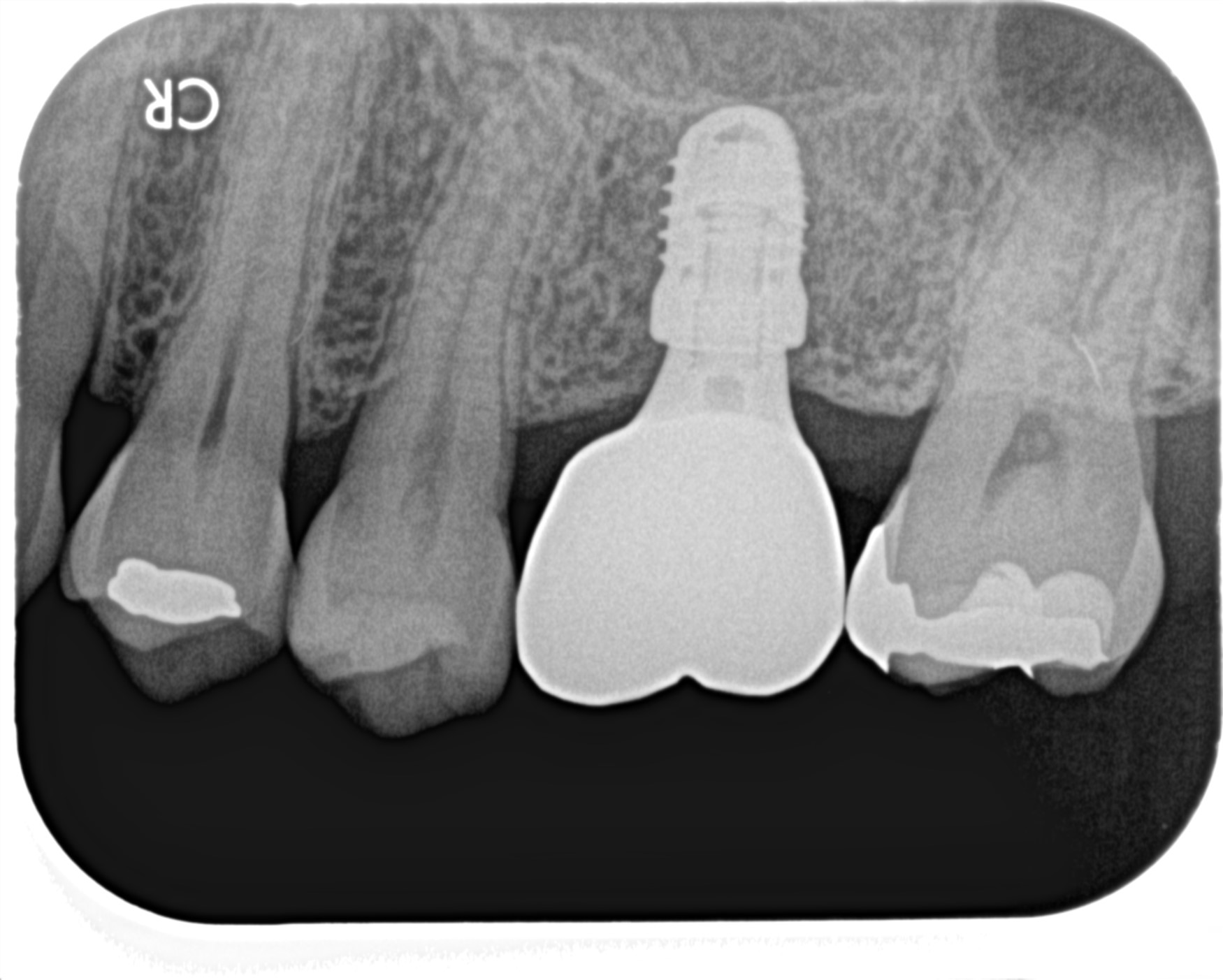 インプラント（単純埋入）