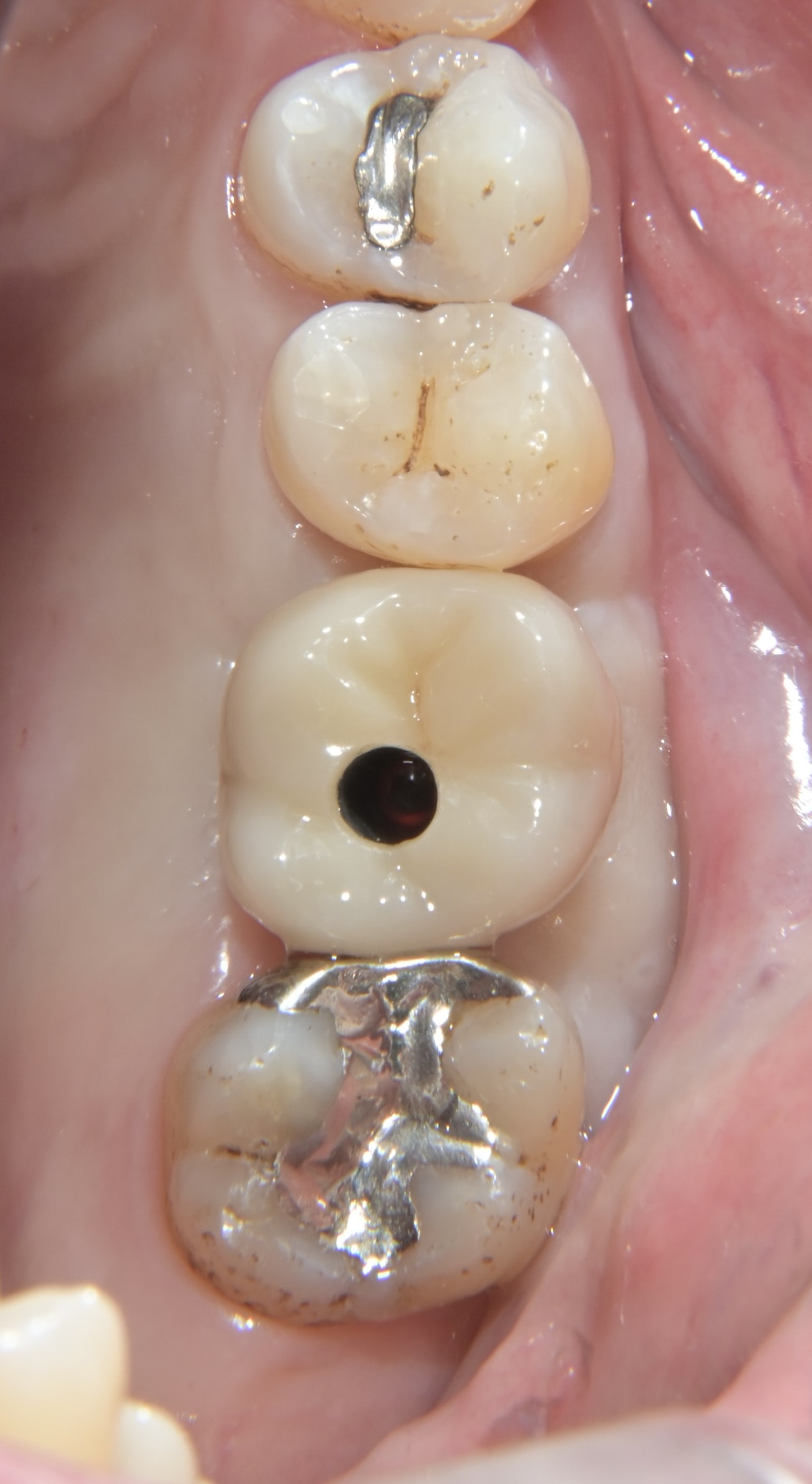 インプラント（単純埋入）