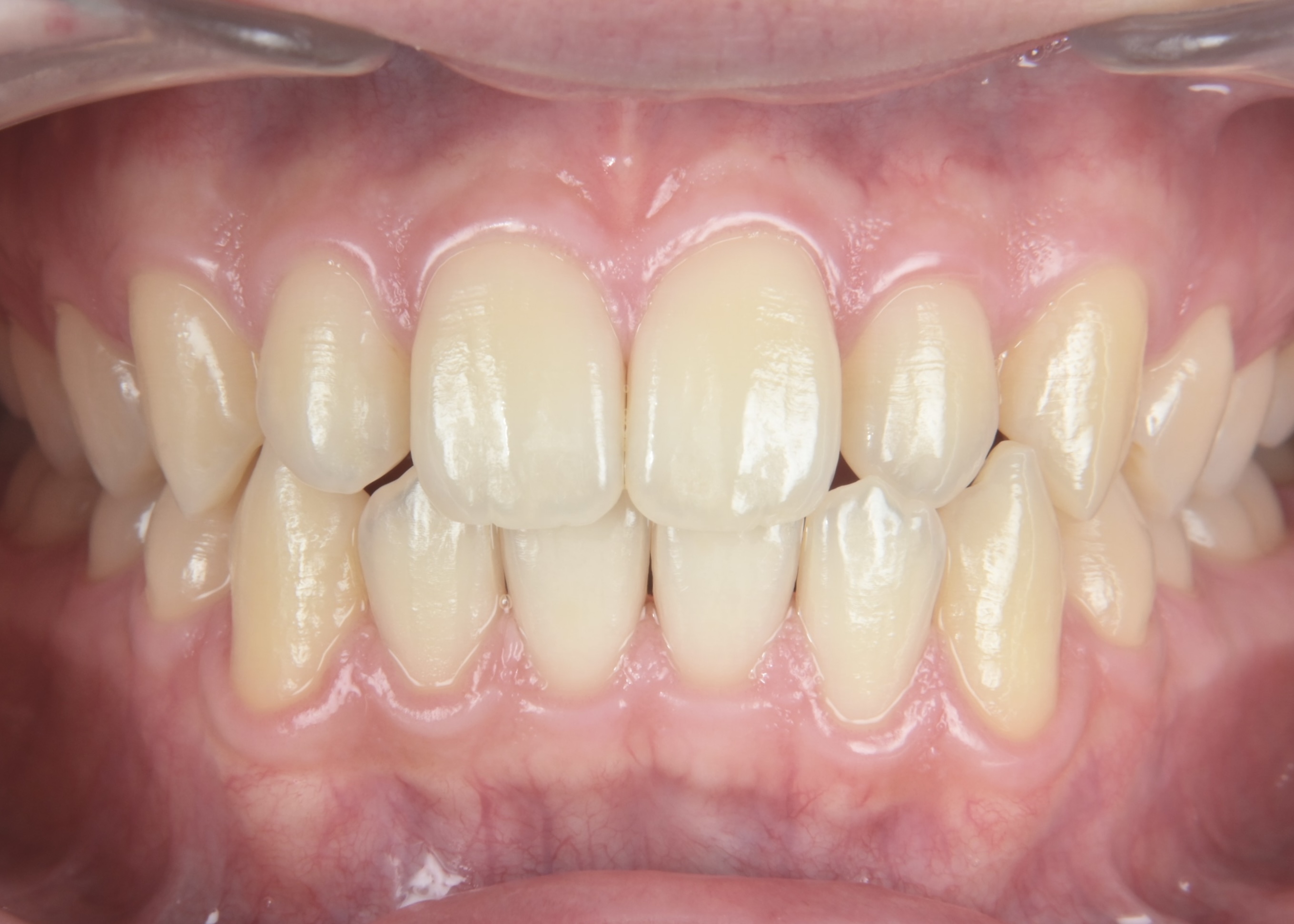 ホワイトニング