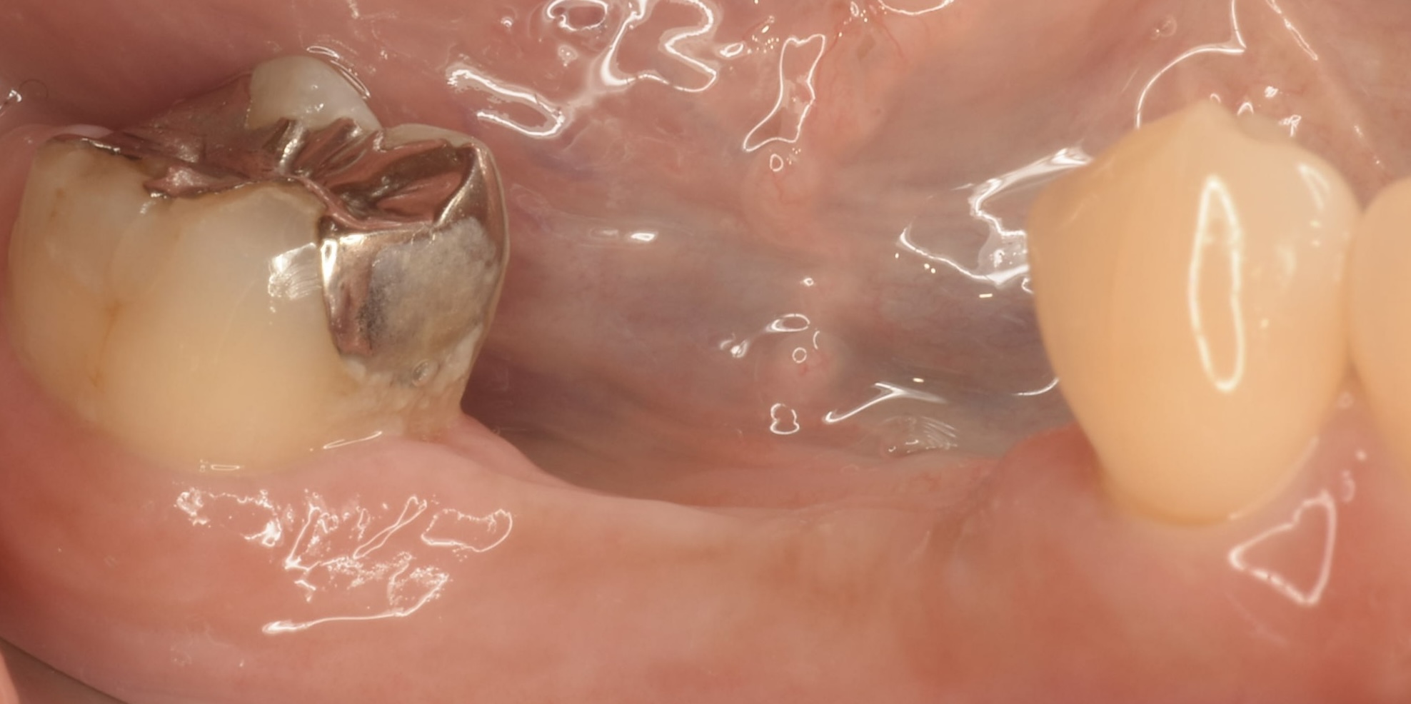 インプラント治療