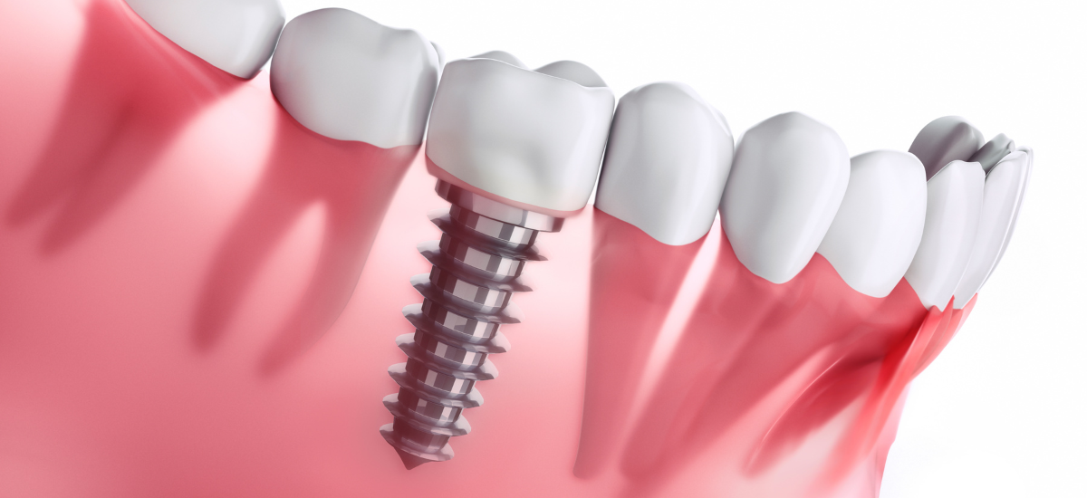 インプラント治療と入れ歯の違いとは?種類ごとの選び方を歯科医が徹底解説
