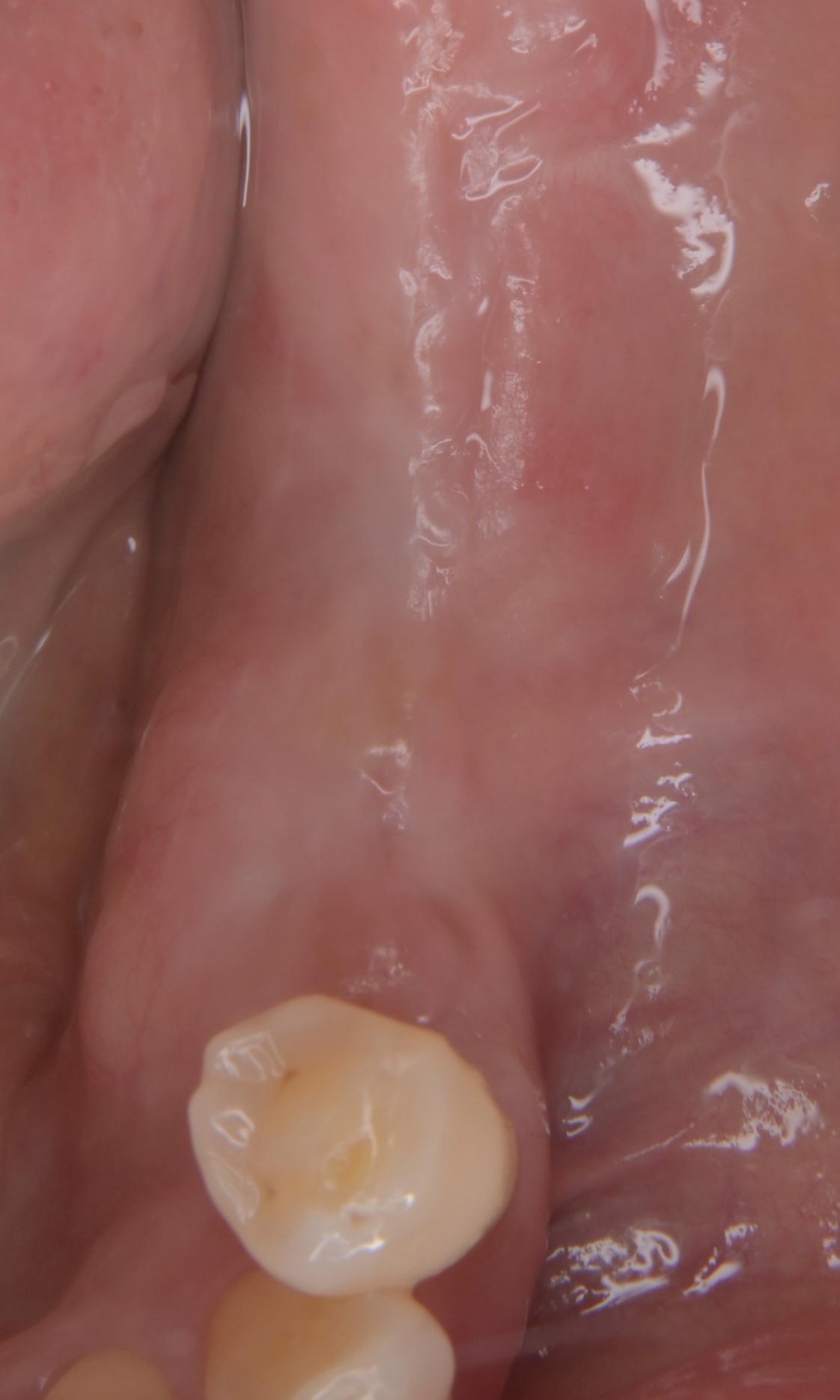 インプラント治療 GBR