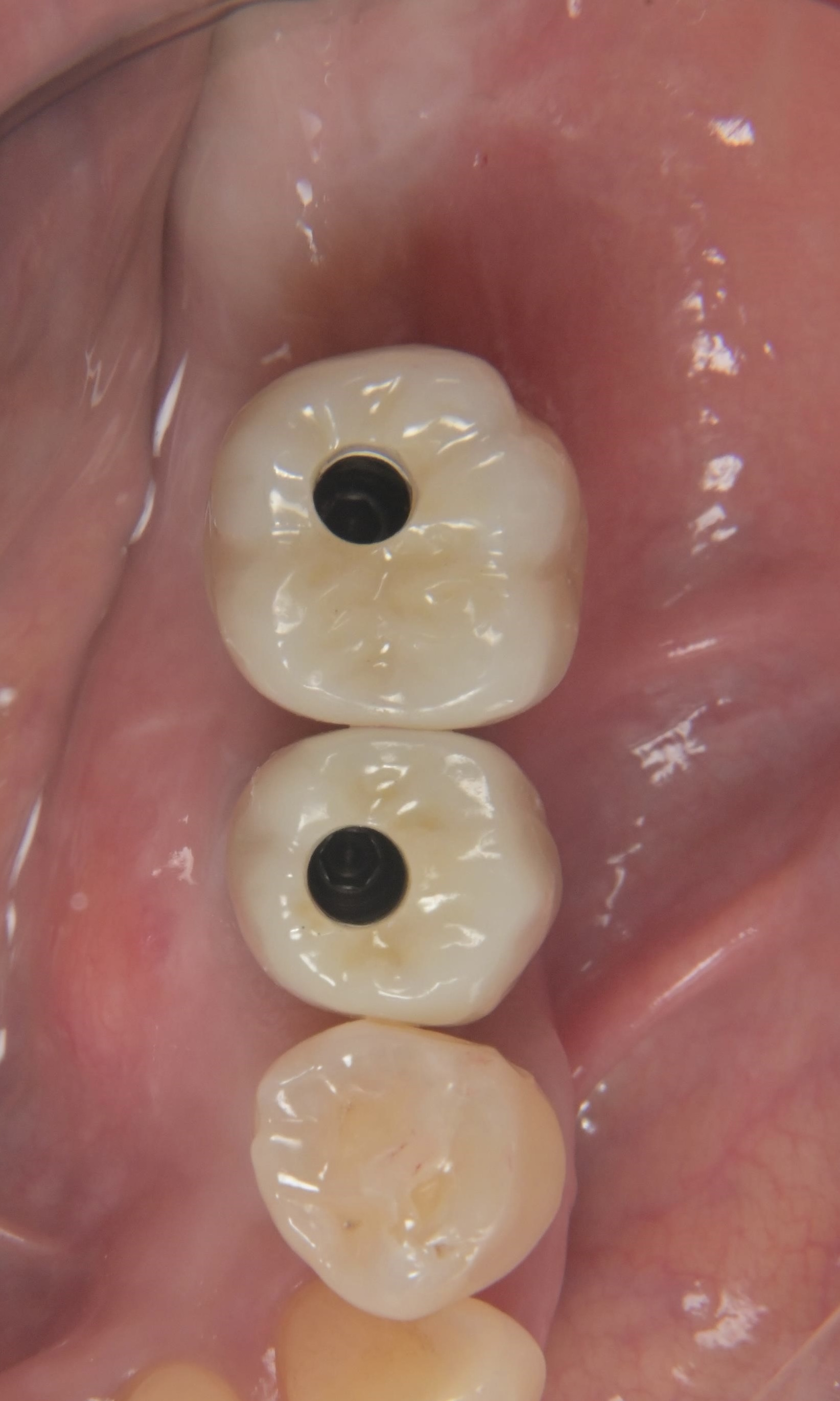 インプラント治療 GBR