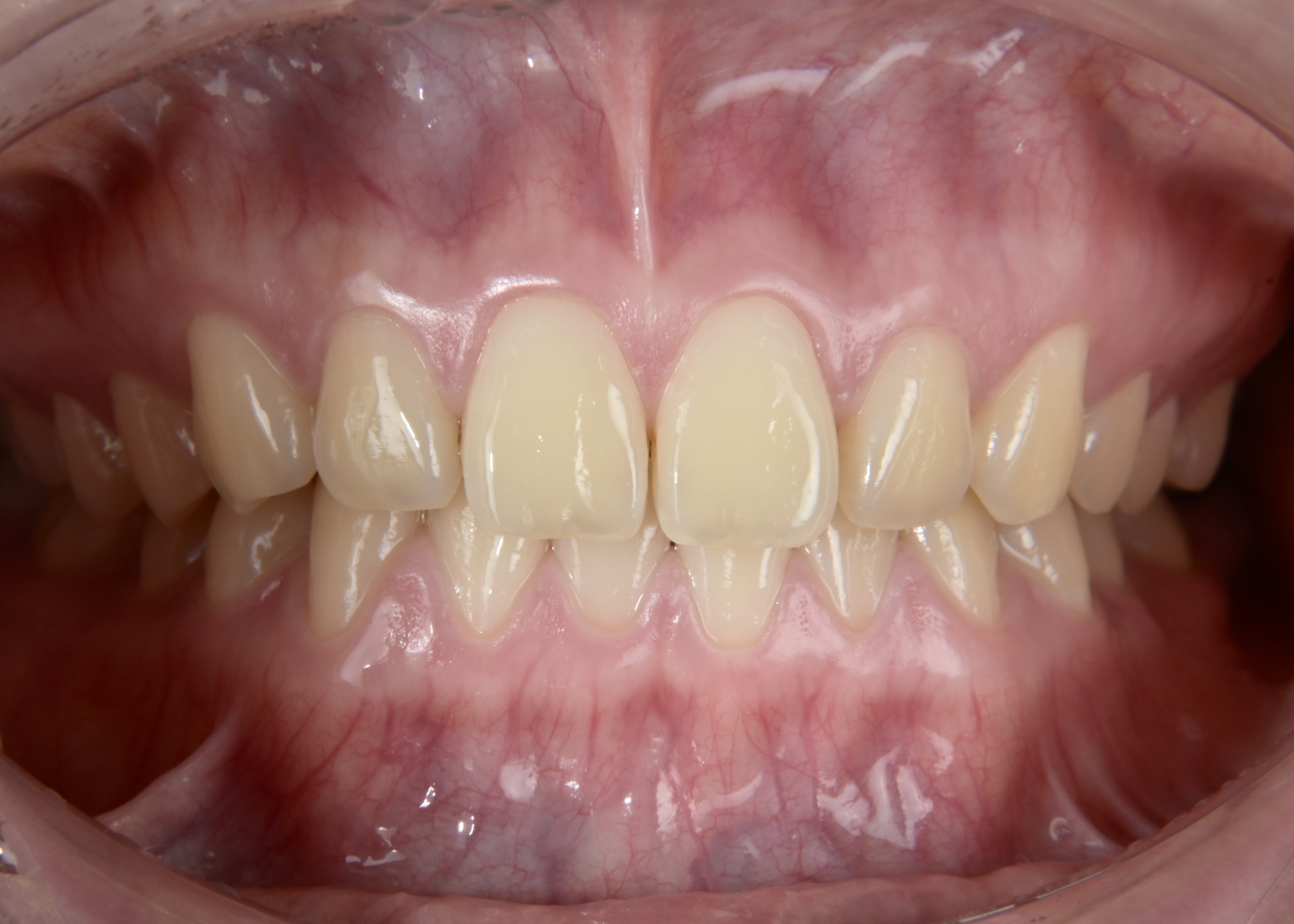 デュアルホワイトニング