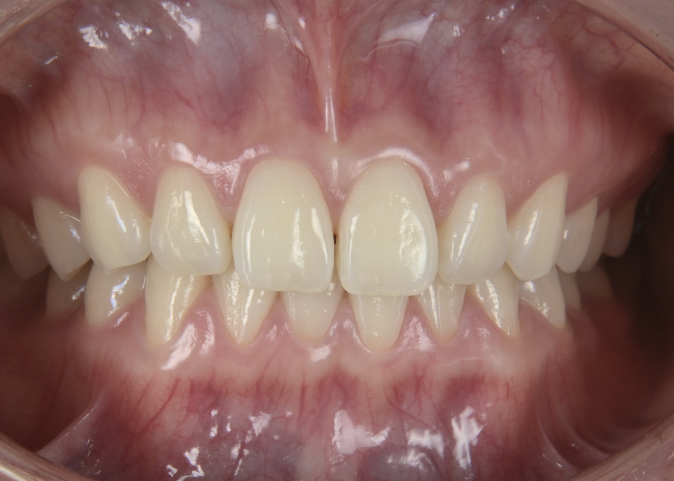 デュアルホワイトニング